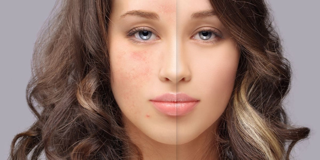 An Expert Guide on How to Treat Acne - No Face Skincare